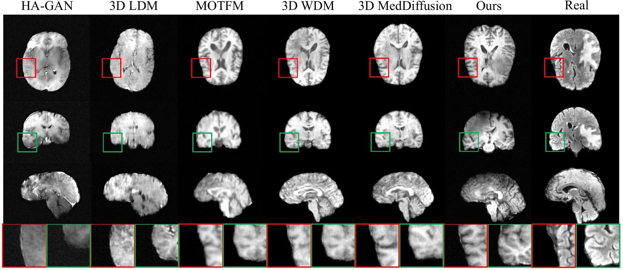 Qualitative comparison of generated pathological brain MRI volumes