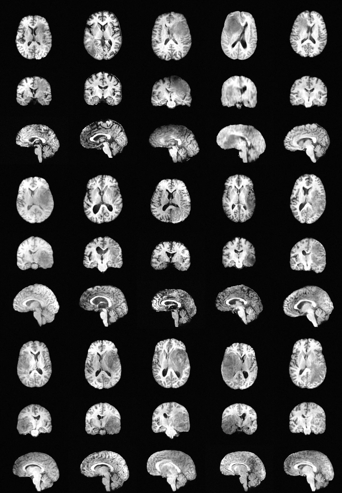 Additional pathological T1 MRI volumes generated by VoxStruct3D